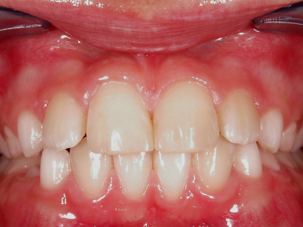 Ästhetische Sofort-Rekonstruktion mit Microglass-Composite